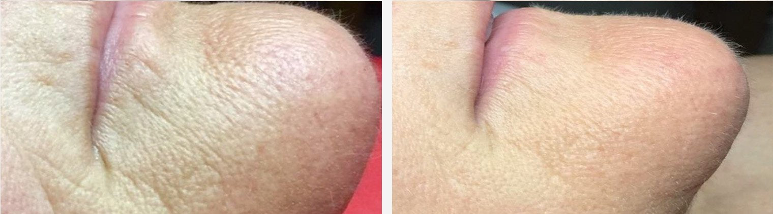 Wrinkles Around Chin Before/After